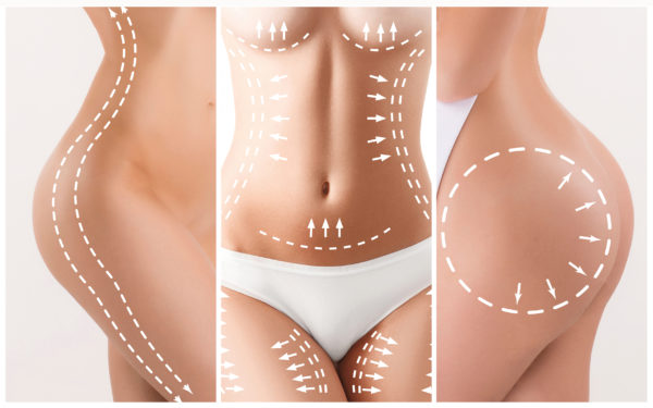 Procedure for liposuction does not erase dimples on skin. 