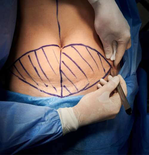 Abdominoplasty procedure