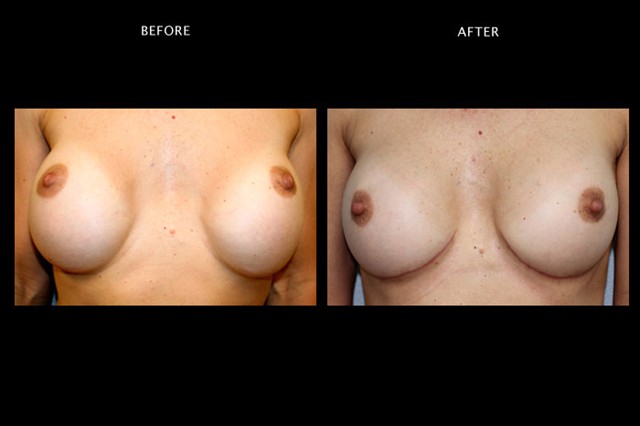 Breast Revisional Augmentation