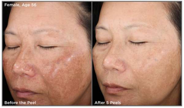 Customized facial peel before and after